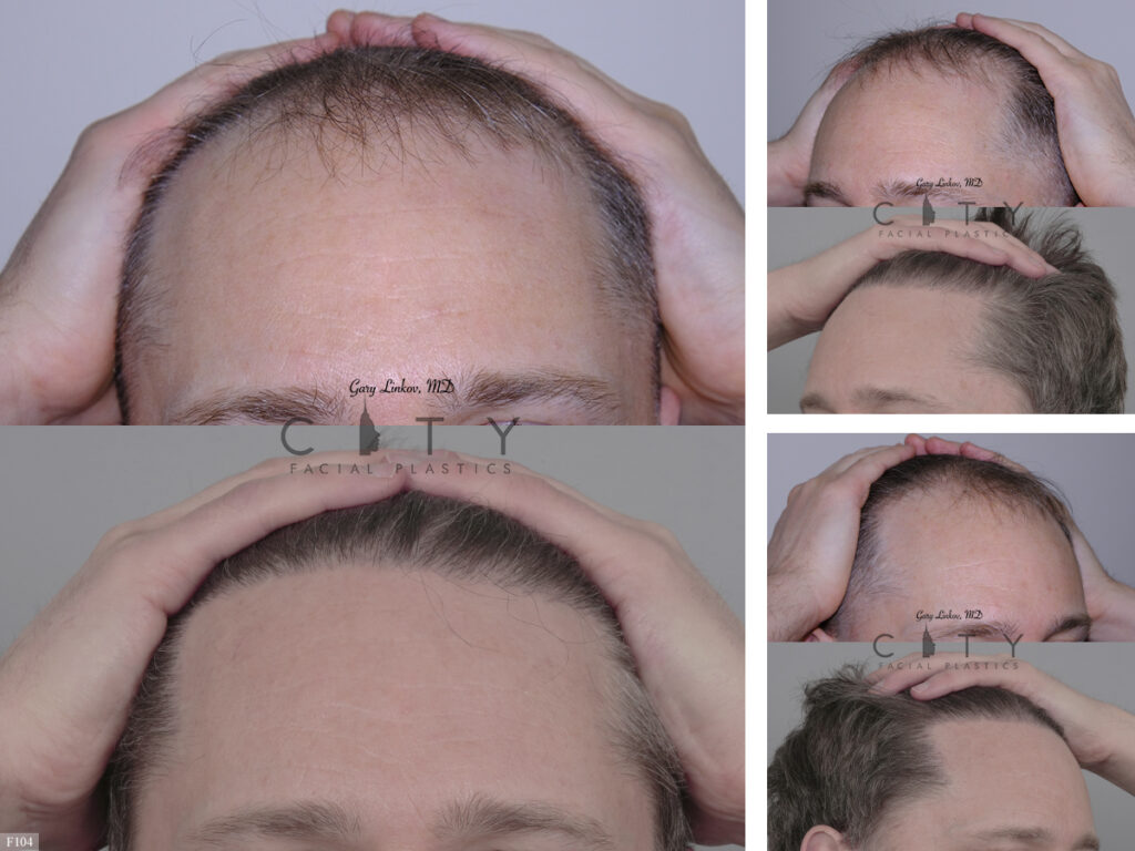 Hair Transplant F104