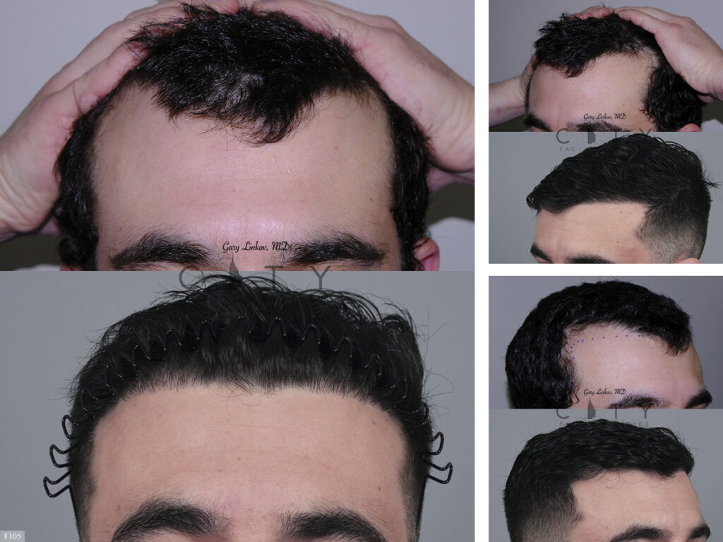 Hair Transplant F105