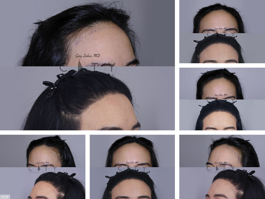 Hair Transplant F110