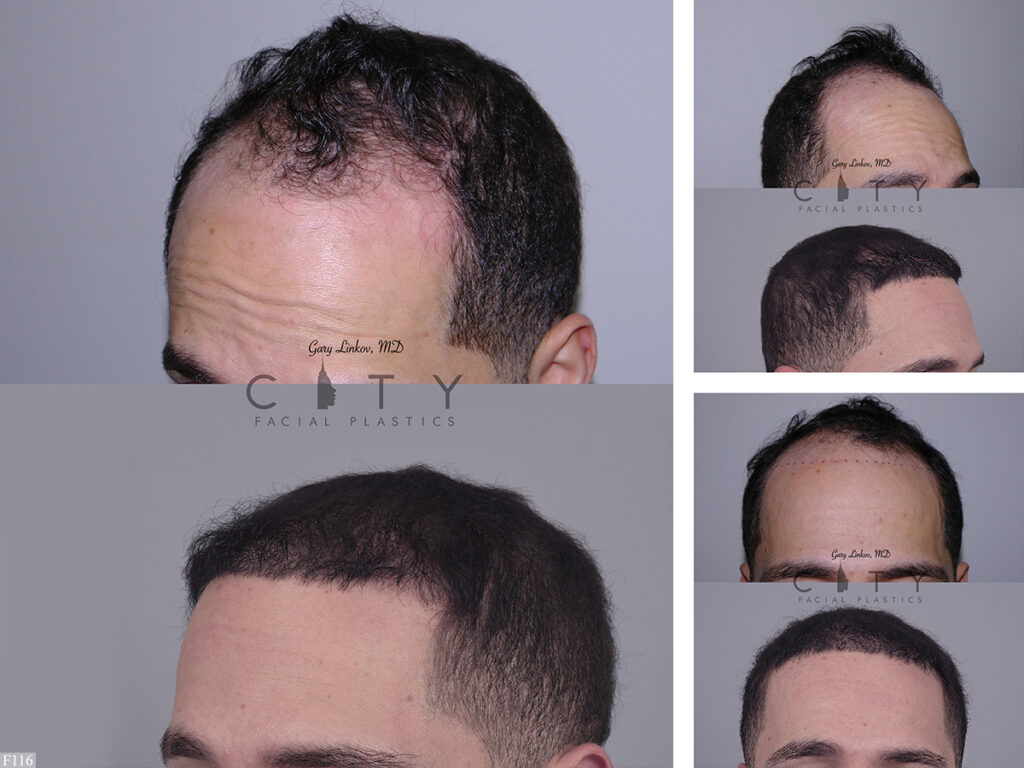 Hair Transplant F116