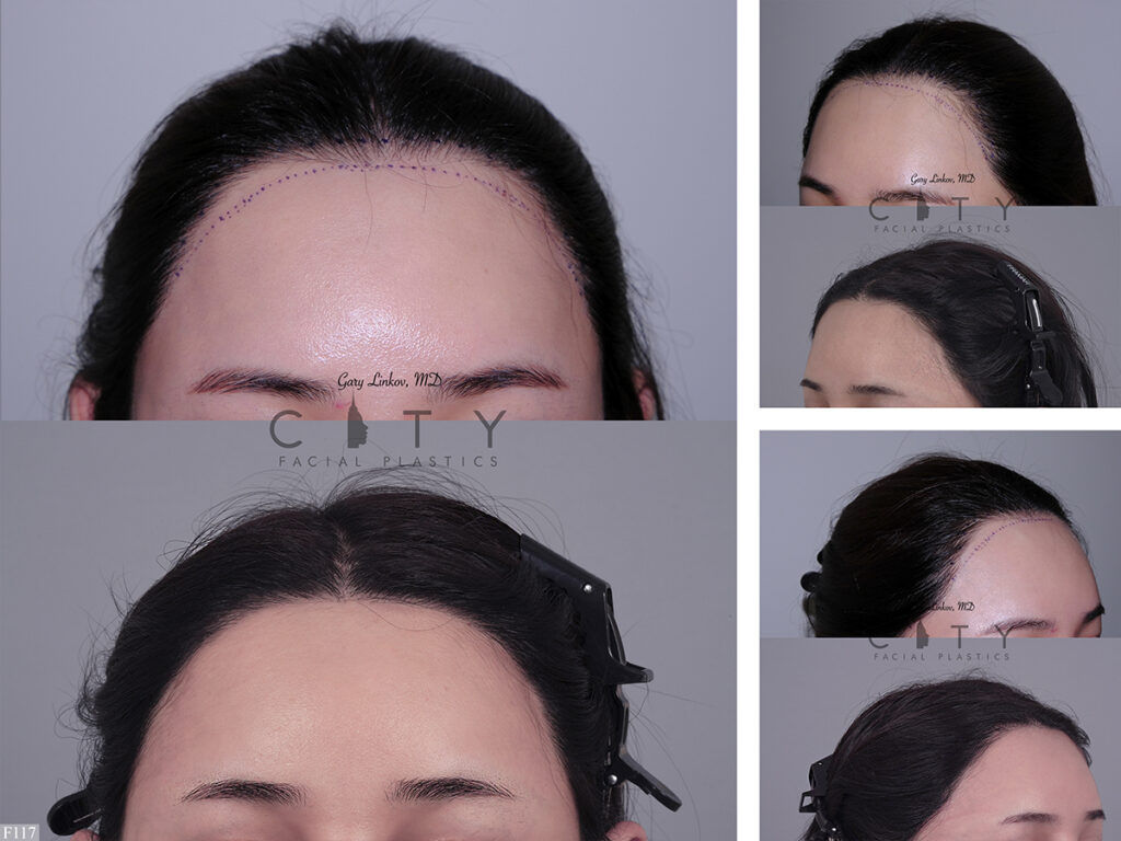 Hair Transplant F117