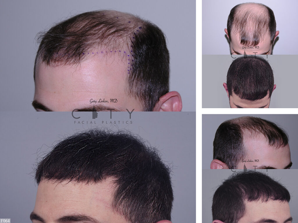 Hair Transplant F064