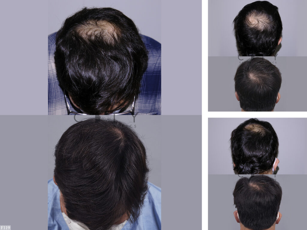 Hair Transplant F119