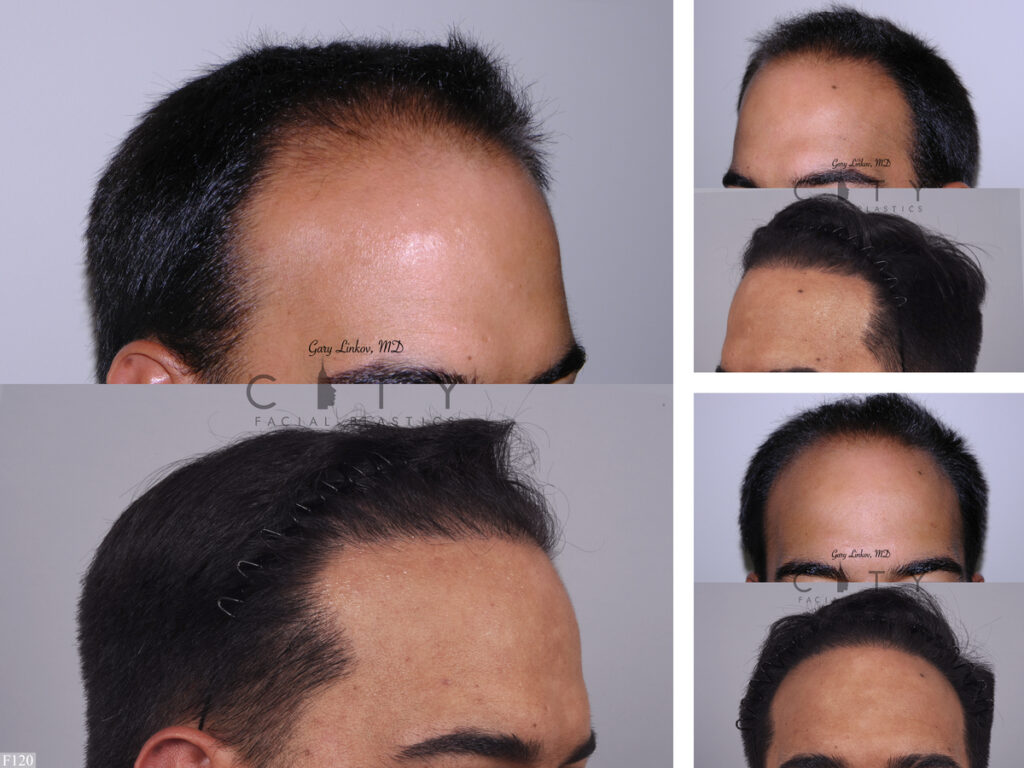 Hair Transplant F120