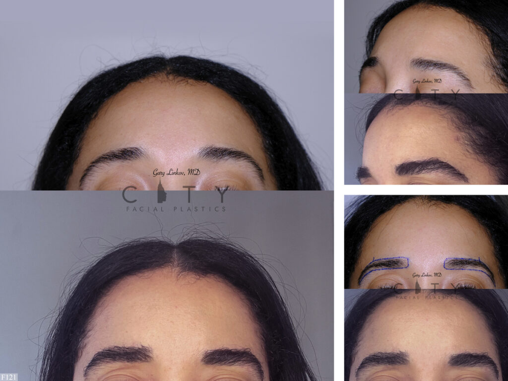 Hair Transplant F121