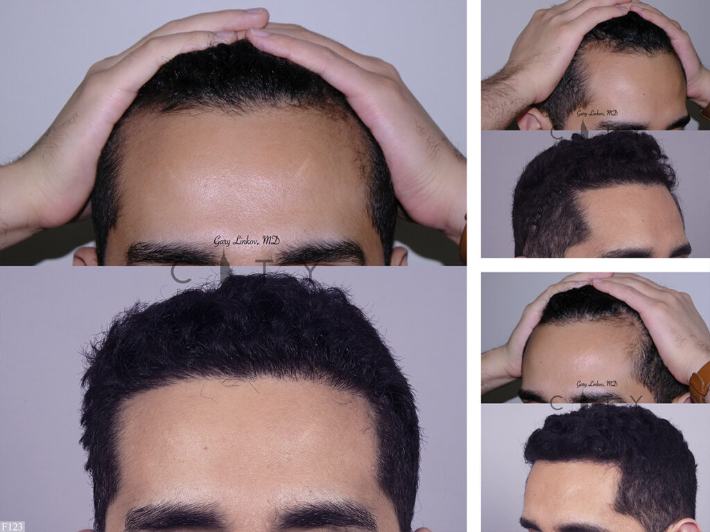 Hair Transplant F123