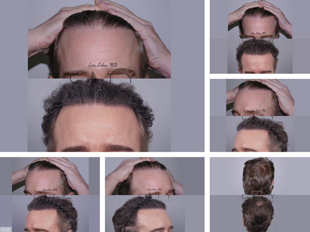 Hair Transplant F124