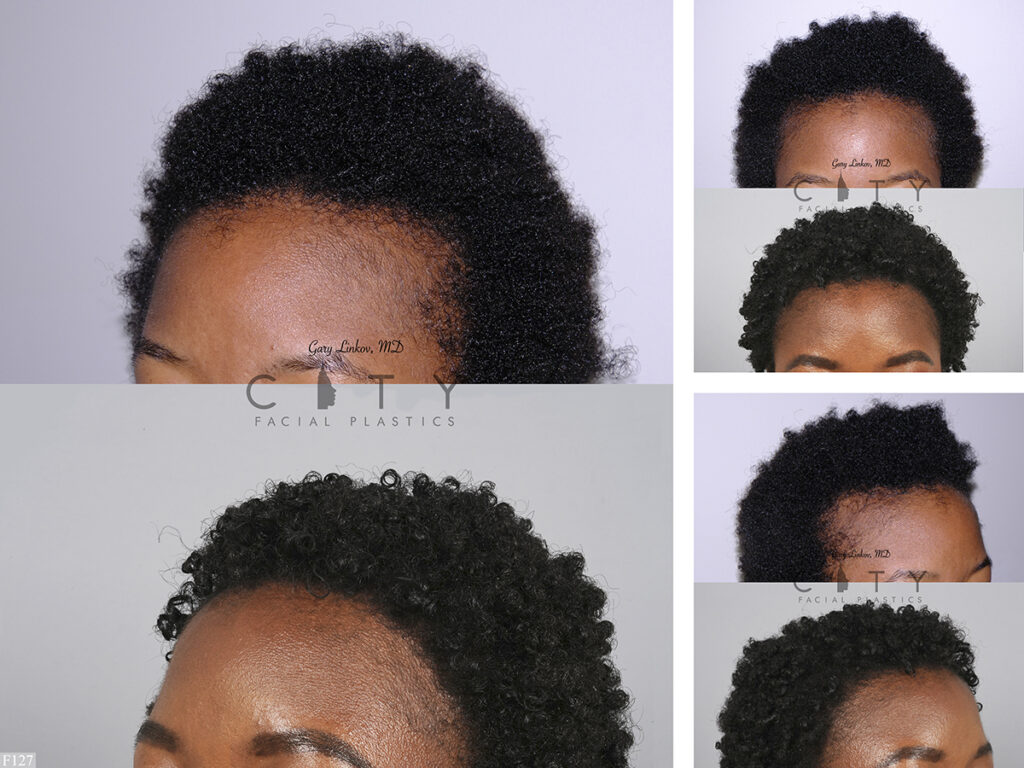 Hair Transplant F127