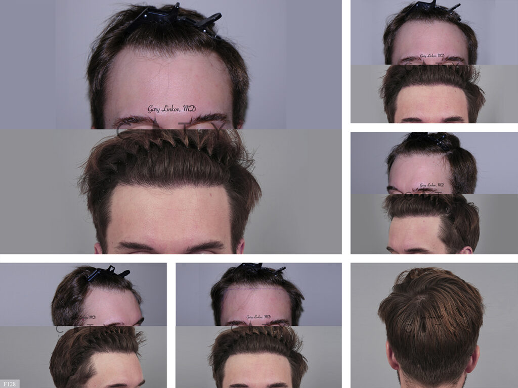 Hair Transplant F128