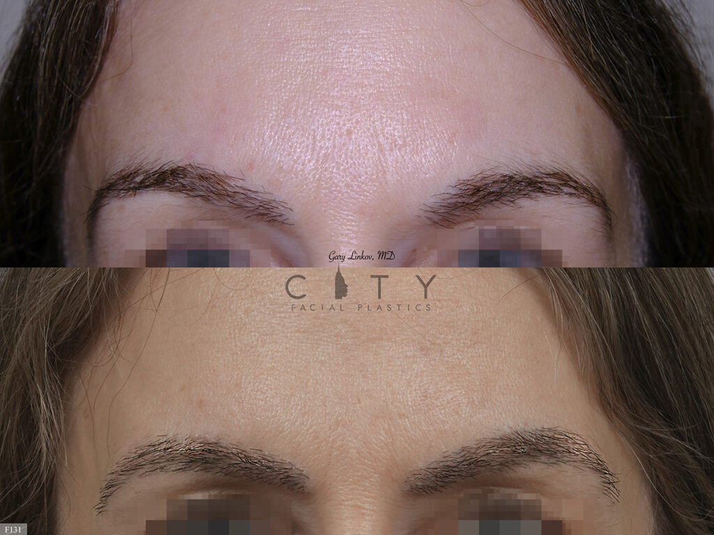 Hair Transplant F131