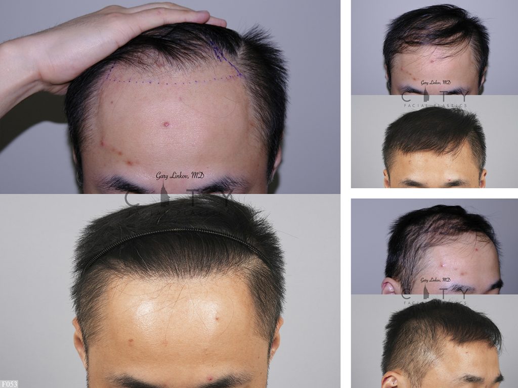 Hair Transplant F053