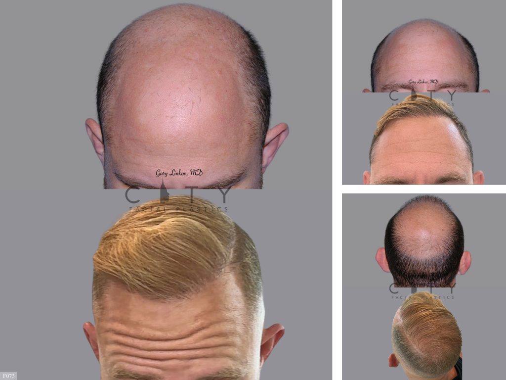 Hair Transplant F073