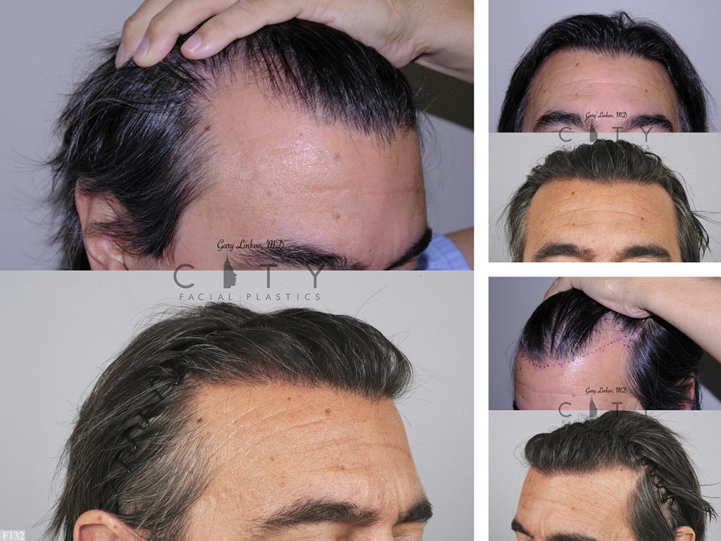 Hair Transplant F132