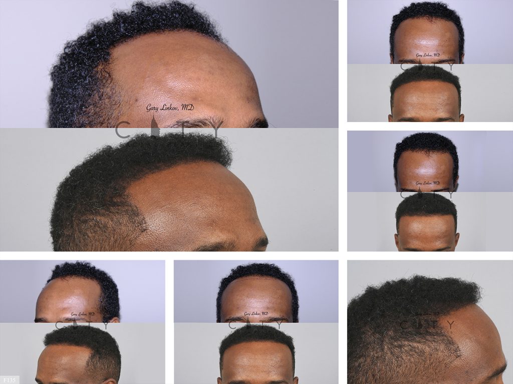 Hair Transplant F135