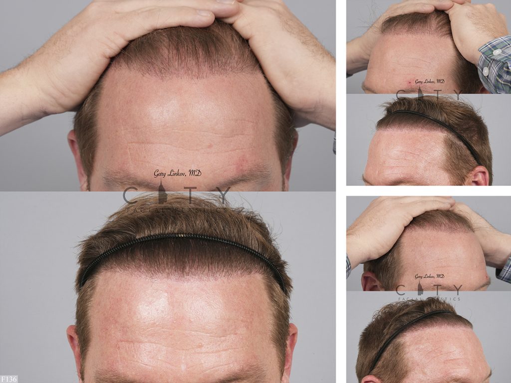 Hair Transplant F136