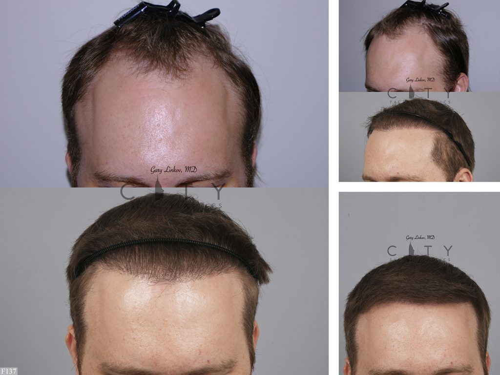 Hair Transplant F137