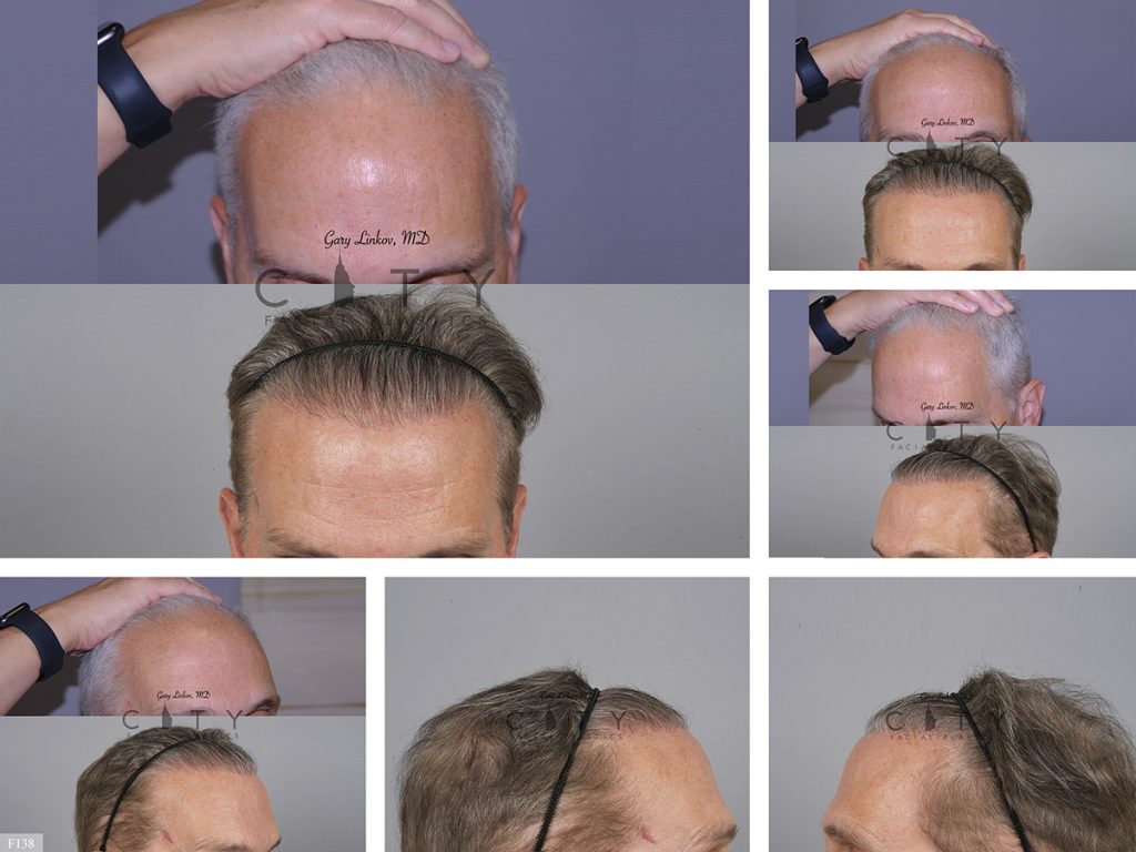 Hair Transplant F138