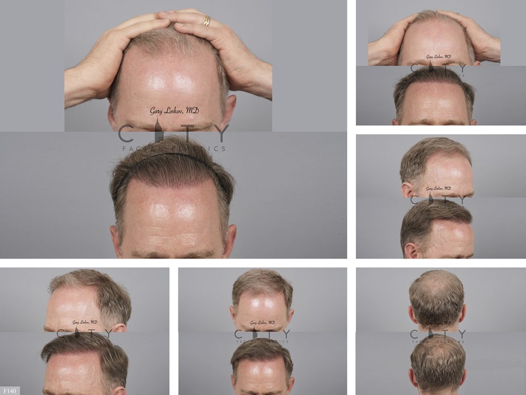 Hair Transplant F140