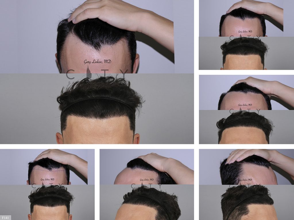 Hair Transplant F141