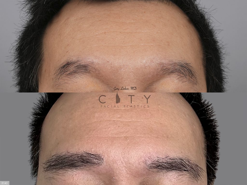 Hair Transplant F143