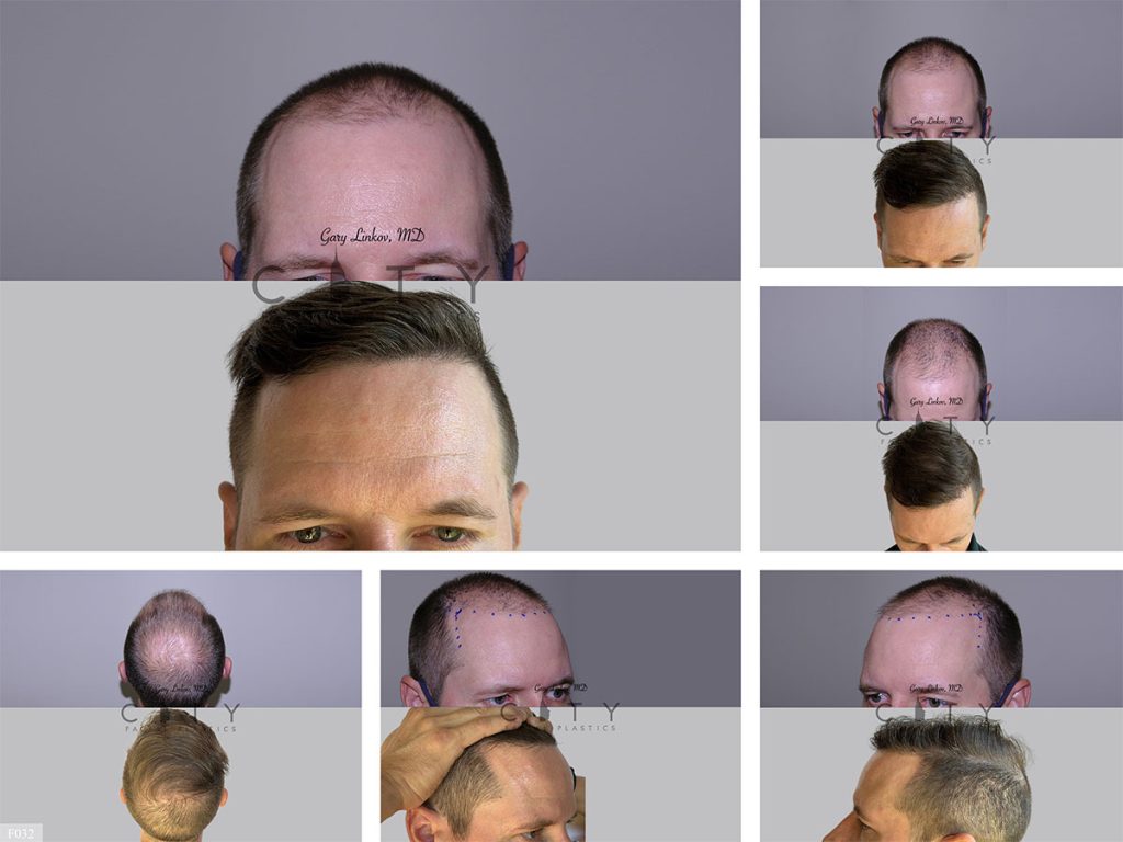 Hair Transplant F032