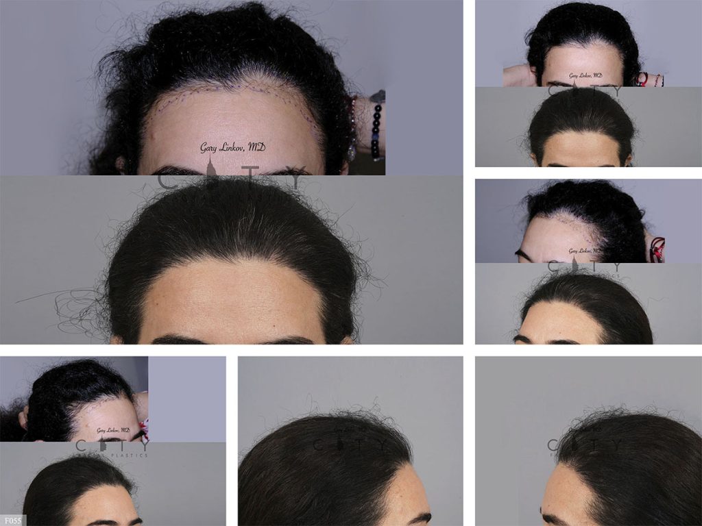 Hair Transplant F055