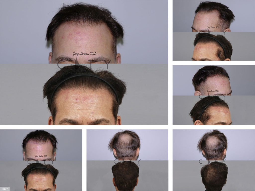 Hair Transplant F077