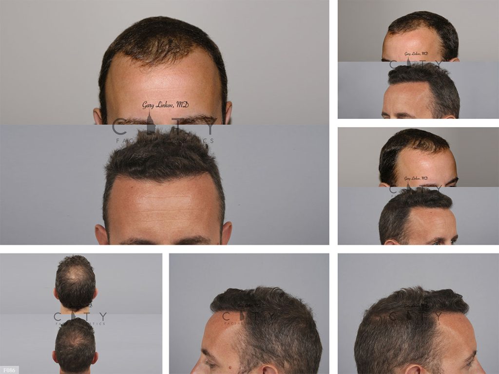 Hair Transplant F086