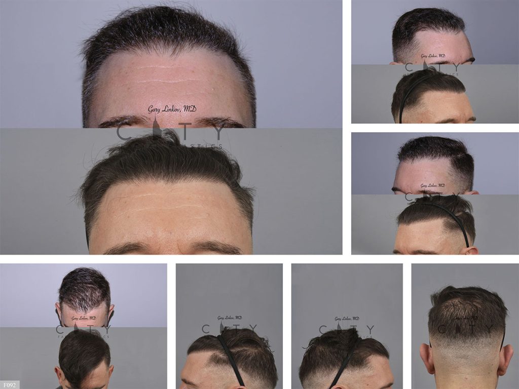 Hair Transplant F092