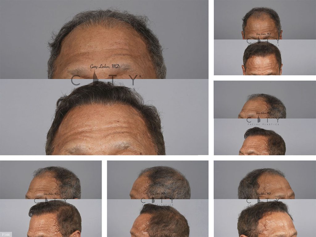 Hair Transplant F144