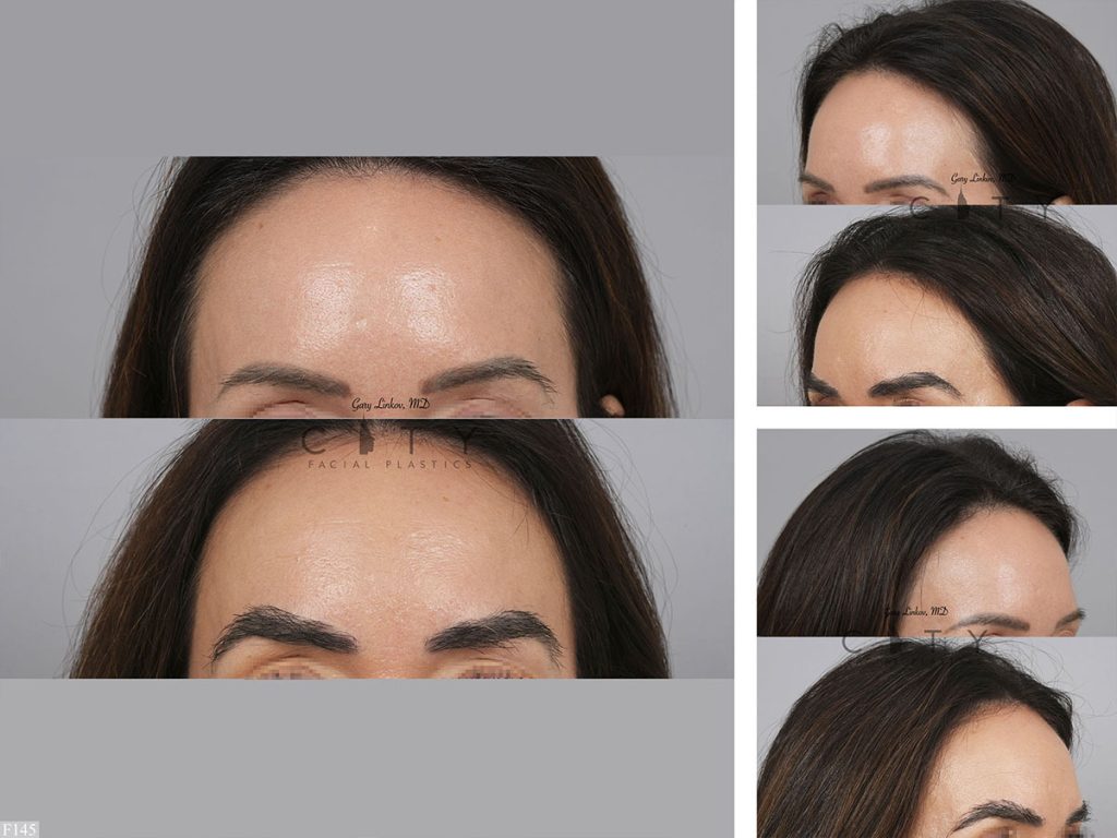 Hair Transplant F145