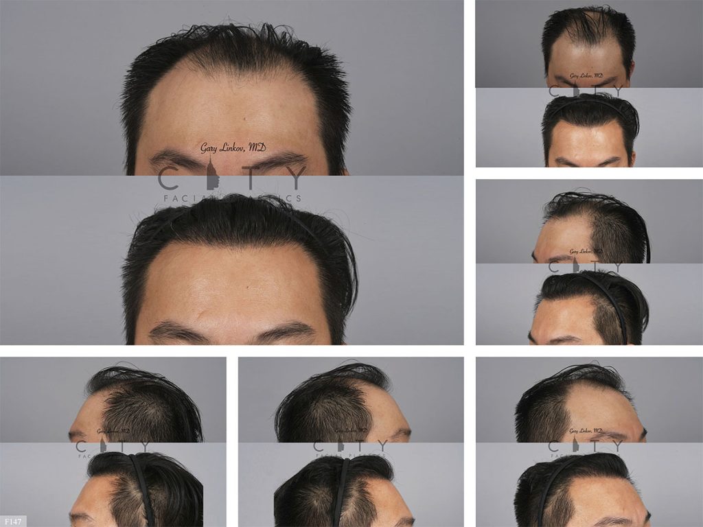 Hair Transplant F147