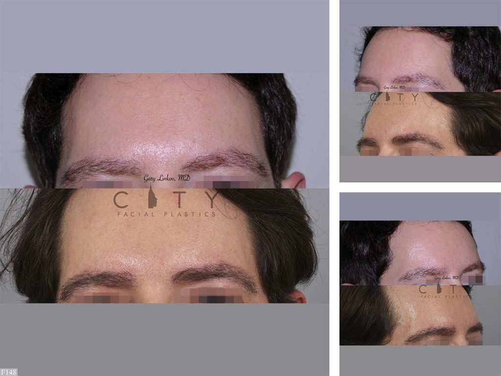 Hair Transplant F148