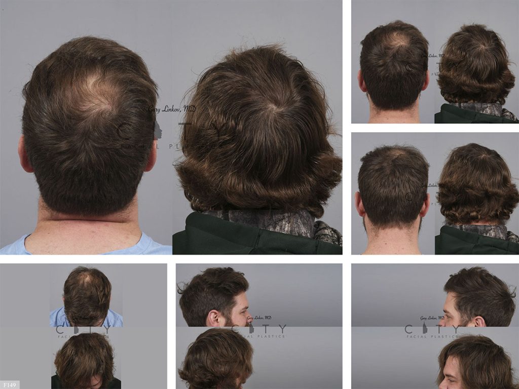 Hair Transplant F149