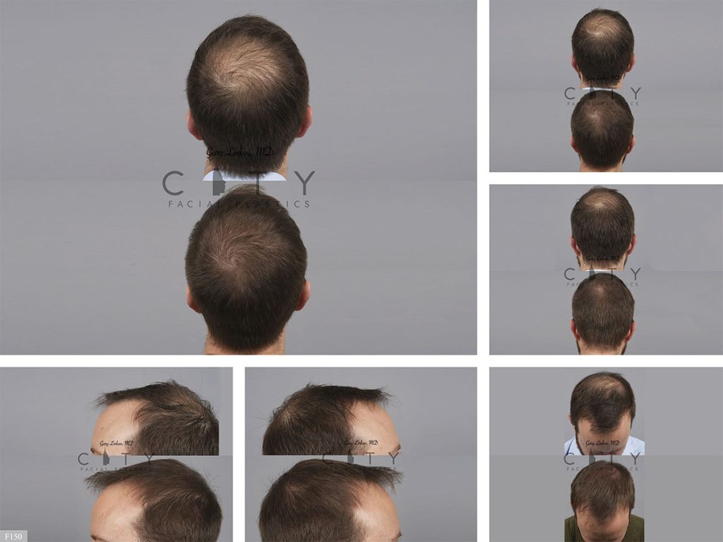 Hair Transplant F150
