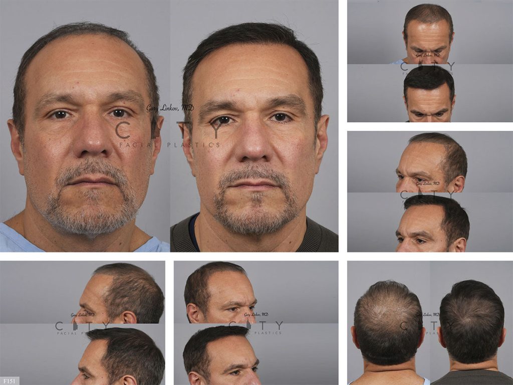 Hair Transplant F151