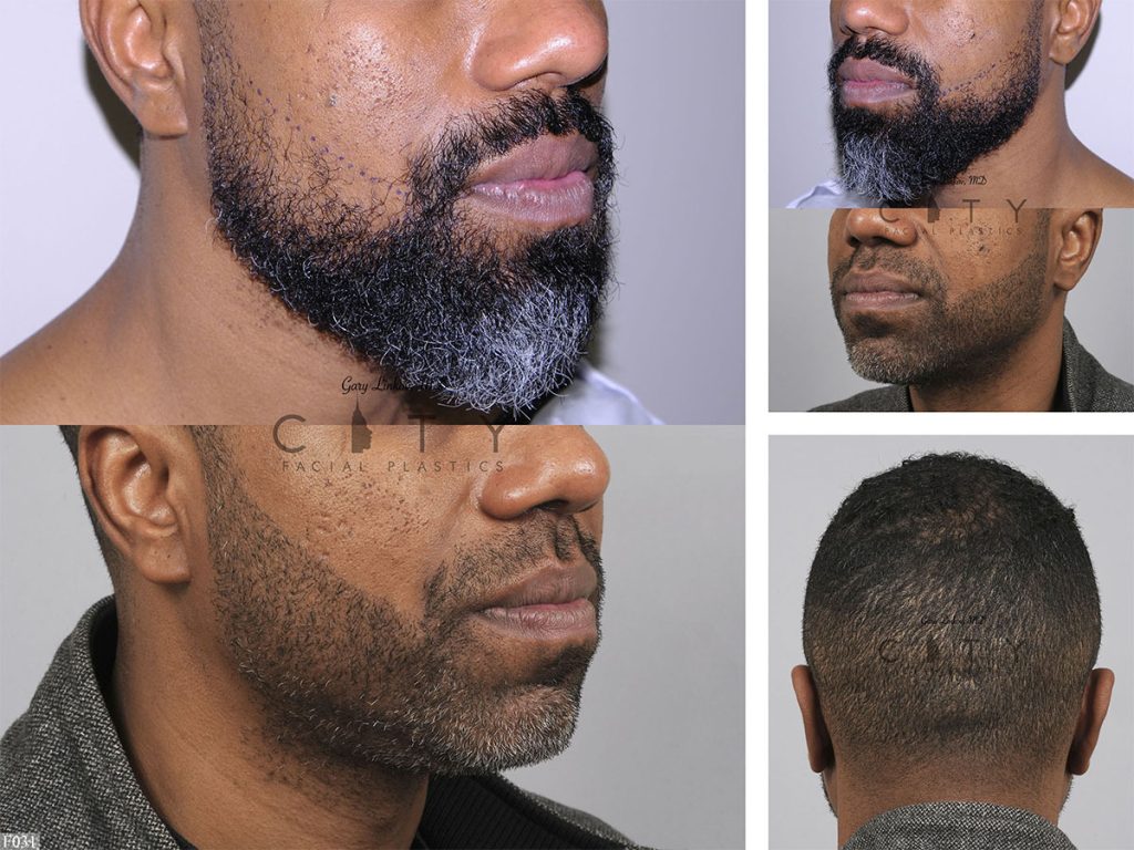 Hair Transplant F031
