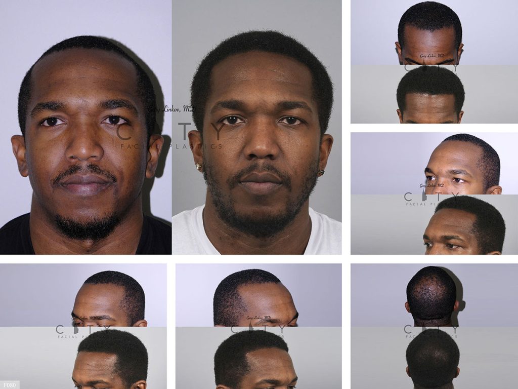 Hair Transplant F080