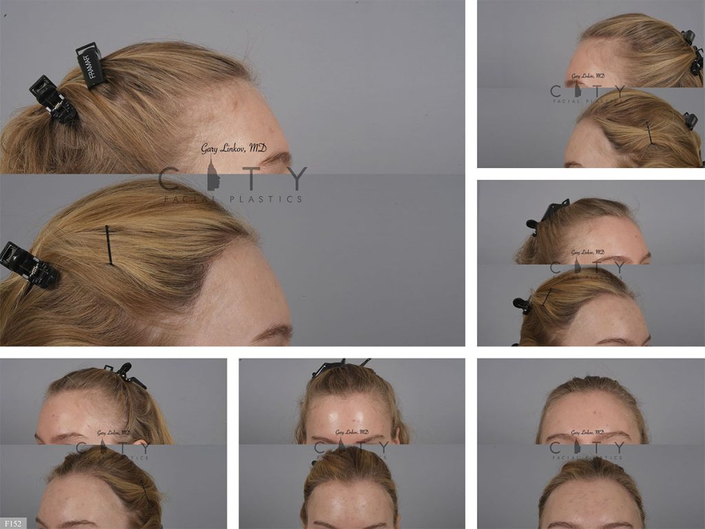 Hair Transplant F152