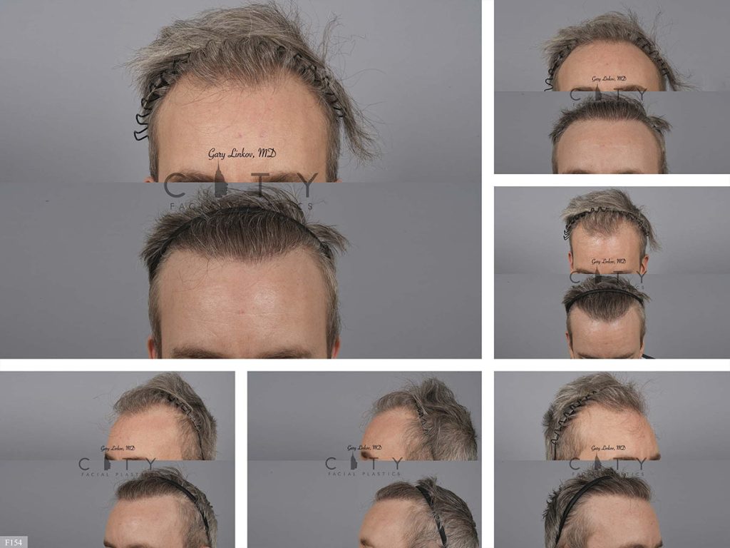 Hair Transplant F154