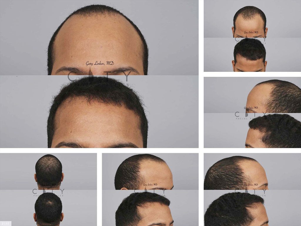 Hair Transplant F155