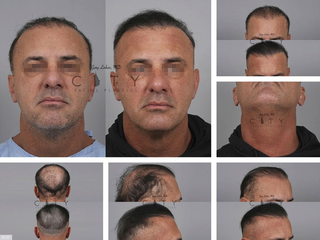 Hair Transplant F157