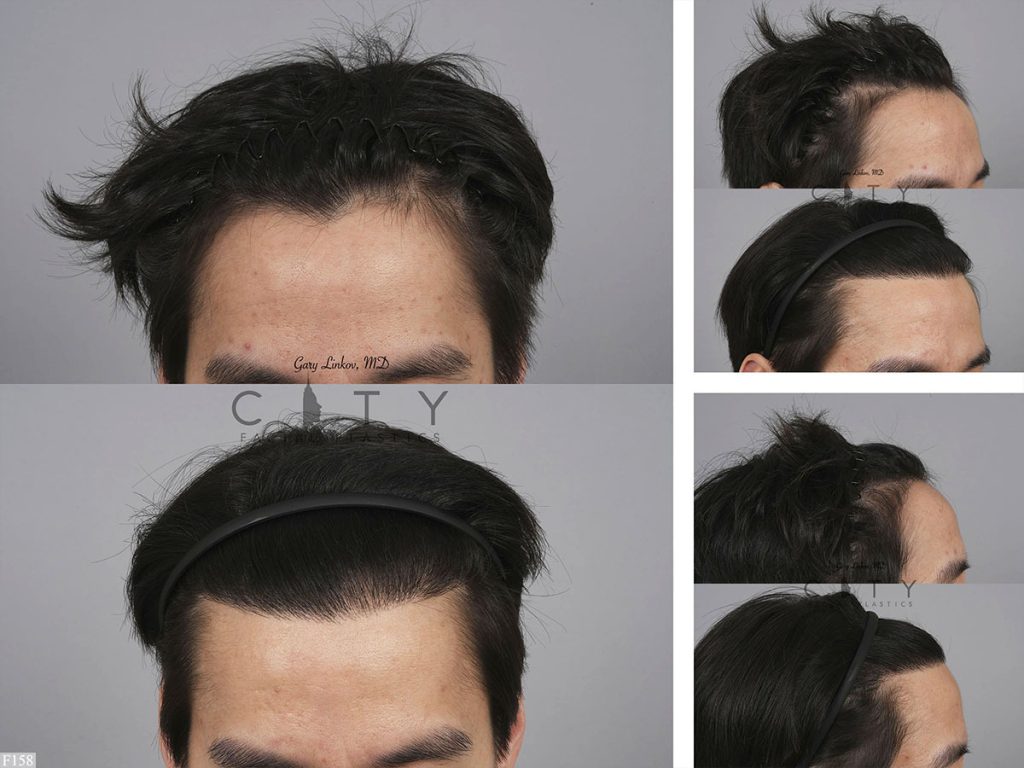 Hair Transplant F158