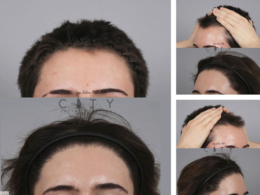 Hair Transplant F159