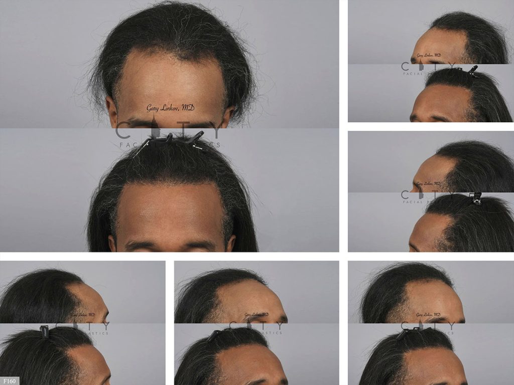 Hair Transplant F160