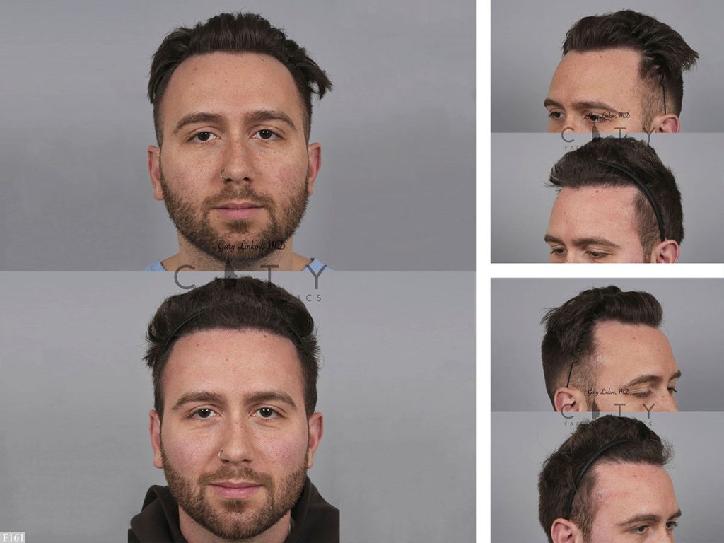 Hair Transplant F161