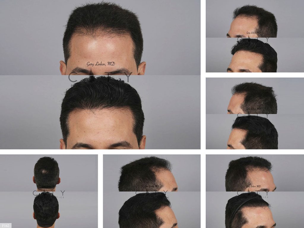 Hair Transplant F162