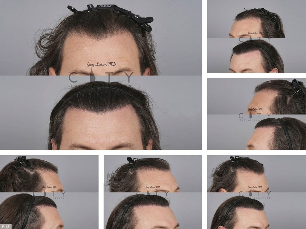 Hair Transplant F163