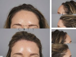 Surgical Hairline Advancement O009