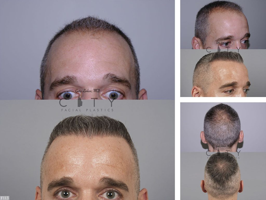 Hair Transplant F113